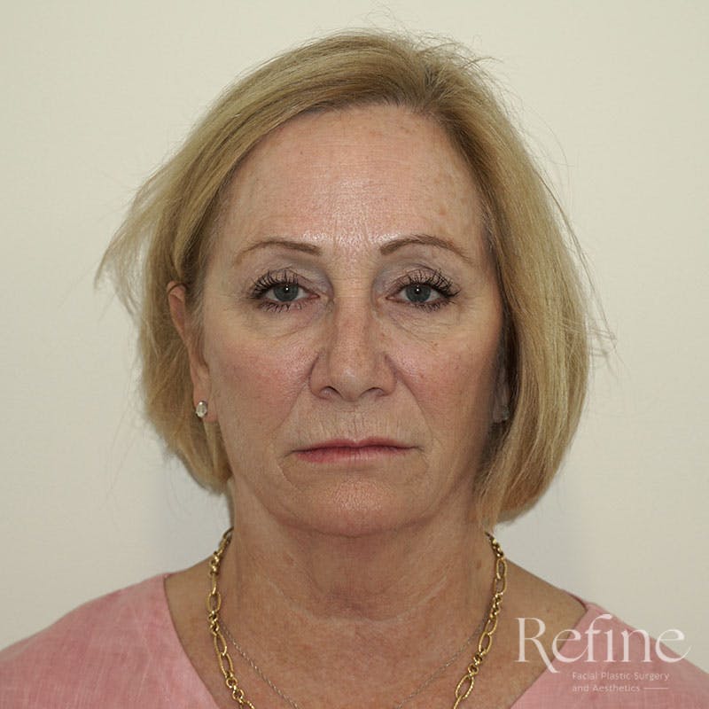 Before and after brow lift surgery in Nashville at Refine Facial Plastic Surgery