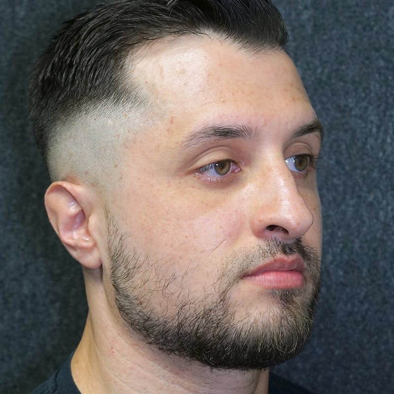 Male Rhinoplasty in Nashville Before & After