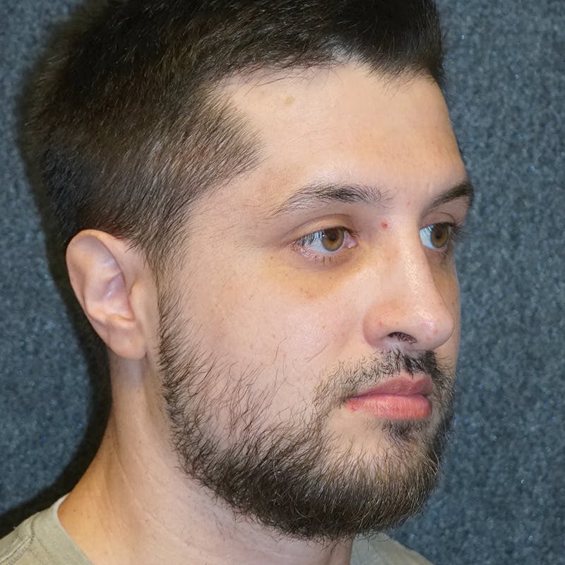 Male Rhinoplasty in Nashville Before & After