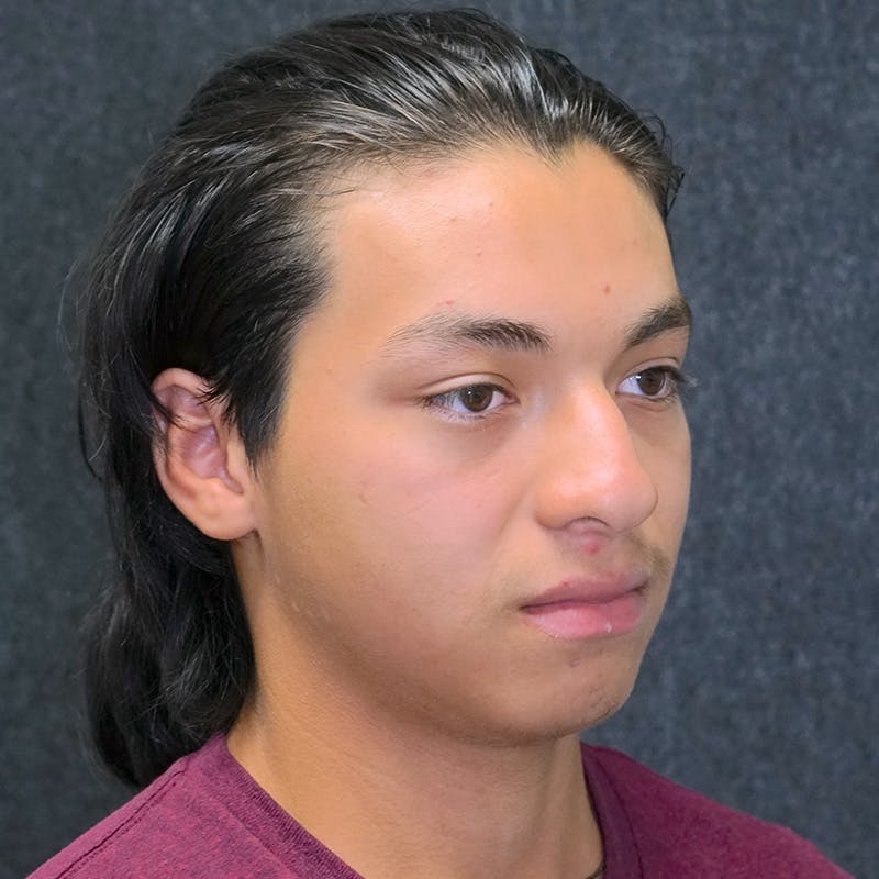 Male Rhinoplasty in Nashville Before & After