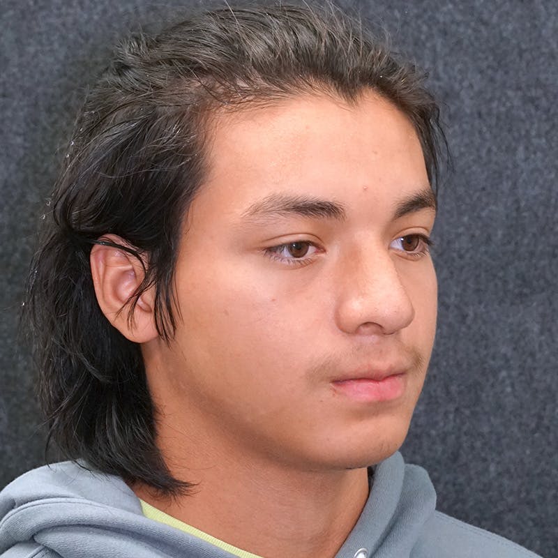 Male Rhinoplasty in Nashville Before & After