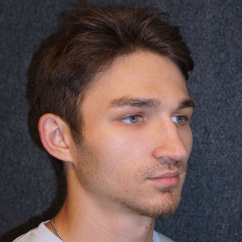 Male Rhinoplasty in Nashville Before & After