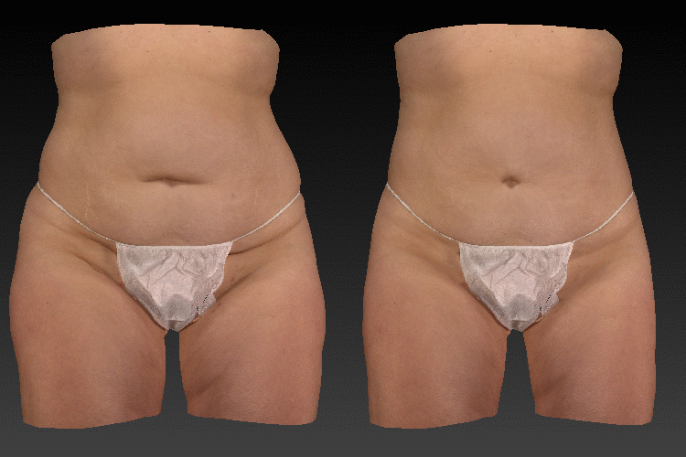 animation of a 3-d consultation for a thigh lift