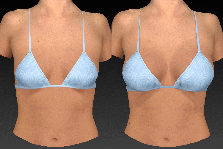 animation of a 3-d consultation for breast augmentation