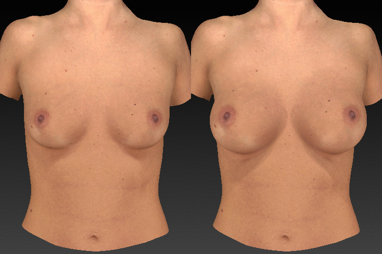 3-d animation of a breast augmentation