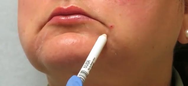 a close up of a woman's chin and lips and a white pencil used to place markings on the face