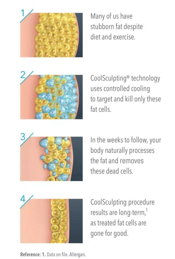 animated image showing what happens to fat during a CoolSculpting session