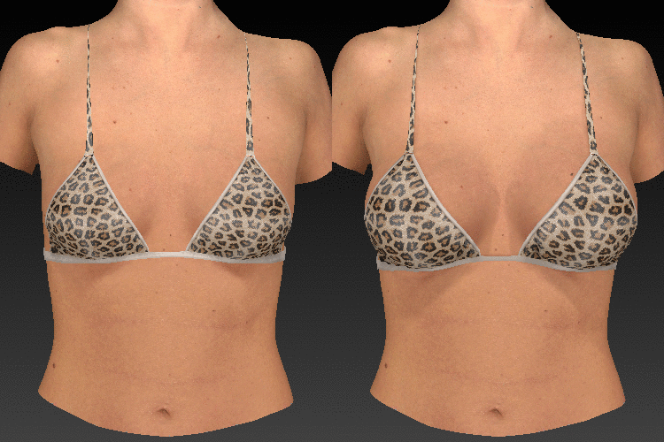 3-D animation of a breast augmentation consultation