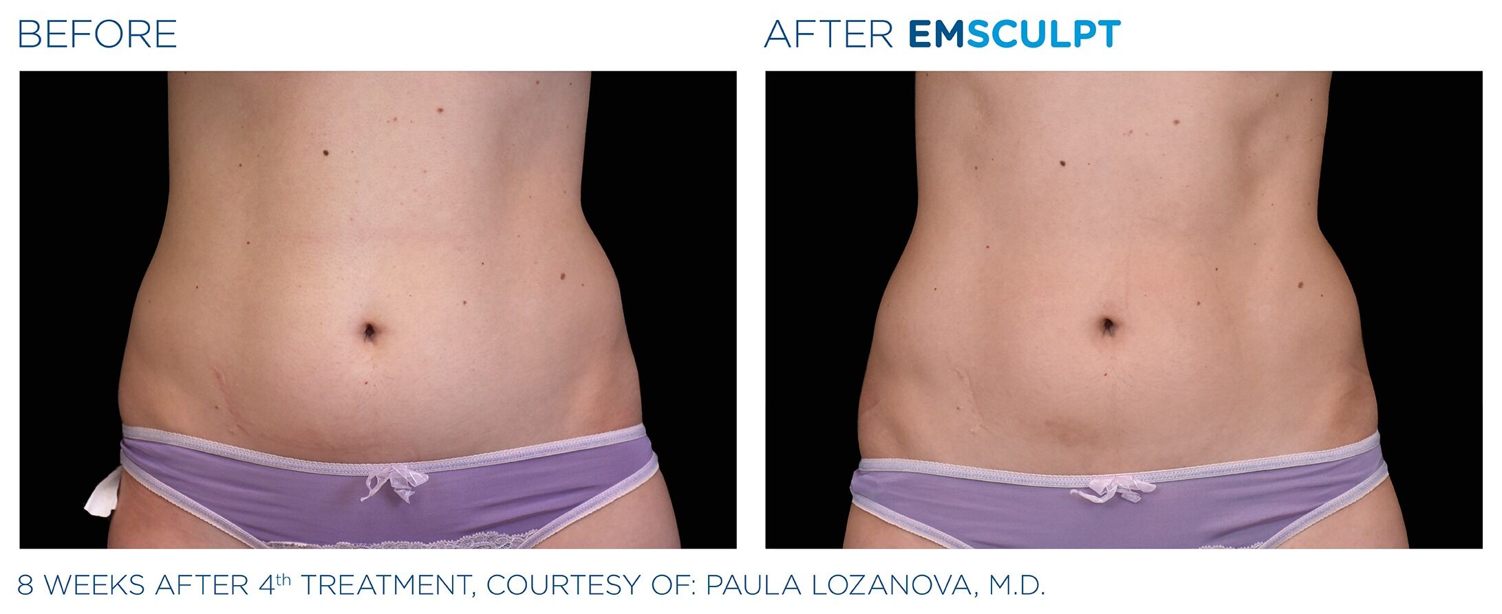 emsculpt Before & After | Shwetambara Parakh, MD, FACS