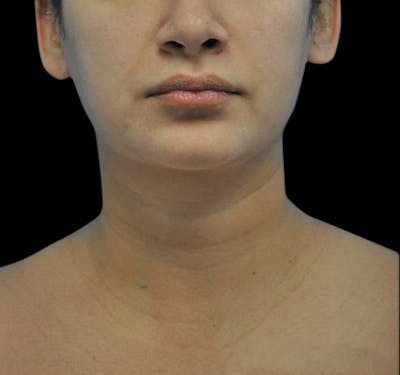 Facial Liposuction Before & After Gallery - Patient 55432560 - Image 1