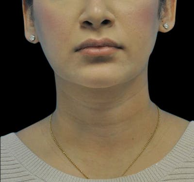 New Jersey Facial Liposuction Before & After Gallery - Patient 55432560 - Image 2