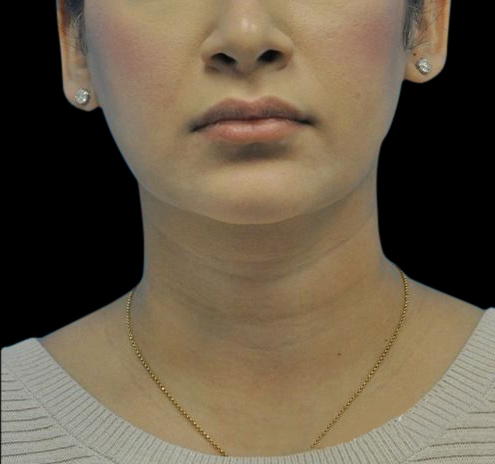 Facial Liposuction Before & After Gallery - Patient 55438120 - Image 2