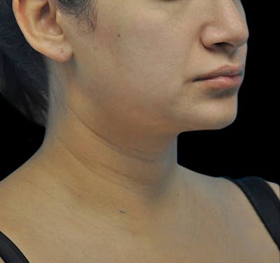 Facial Liposuction Before & After Gallery - Patient 55438120 - Image 3