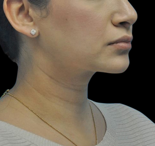 New Jersey Liposuction Before & After Gallery - Patient 55438120 - Image 4