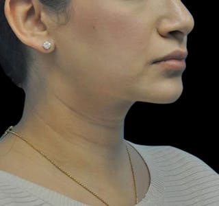 Facial Liposuction Before & After Gallery - Patient 55432560 - Image 4