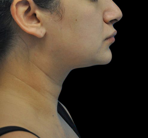 New Jersey Liposuction Before & After Gallery - Patient 55438120 - Image 5