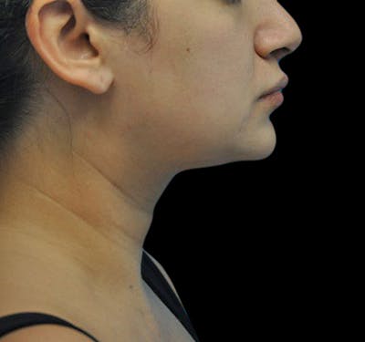 New Jersey Liposuction Before & After Gallery - Patient 55438120 - Image 5