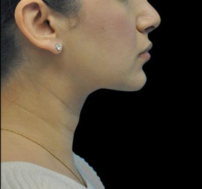 New Jersey Liposuction Before & After Gallery - Patient 55438120 - Image 6