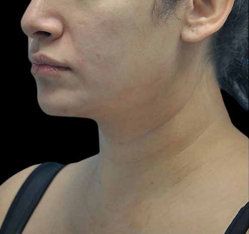New Jersey Facial Liposuction Before & After Gallery - Patient 55438120 - Image 7