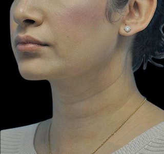 Facial Liposuction Before & After Gallery - Patient 55438120 - Image 8