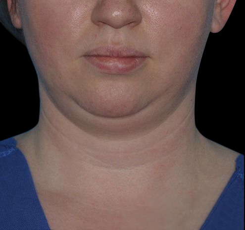 Facial Liposuction Before & After Gallery - Patient 55437783 - Image 1