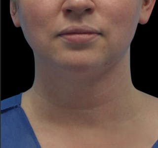 New Jersey Facial Liposuction Before & After Gallery - Patient 55432562 - Image 2
