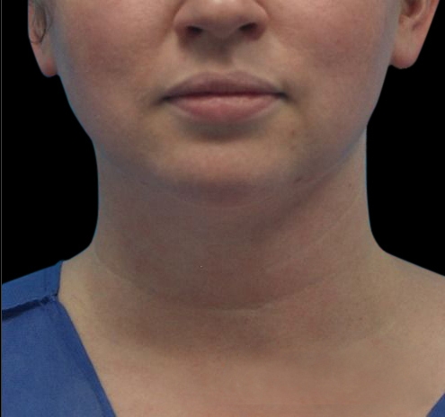 New Jersey Facial Liposuction Before & After Gallery - Patient 55432562 - Image 2