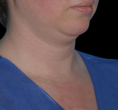 New Jersey Facial Liposuction Before & After Gallery - Patient 55437783 - Image 3