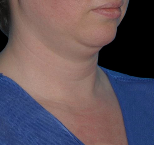 New Jersey Facial Liposuction Before & After Gallery - Patient 55432562 - Image 3
