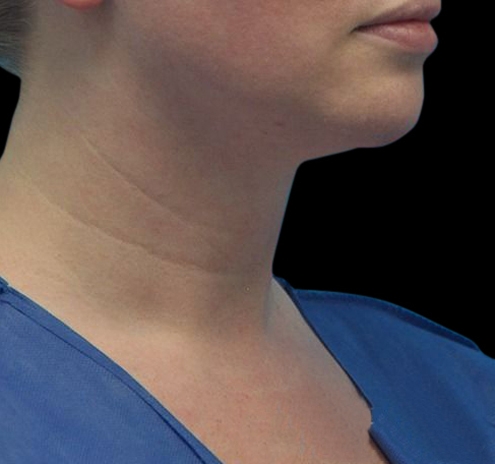 New Jersey Facial Liposuction Before & After Gallery - Patient 55437783 - Image 4