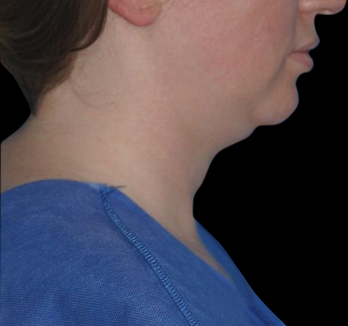 Facial Liposuction Before & After Gallery - Patient 55432562 - Image 7