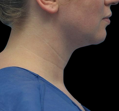 New Jersey Liposuction Before & After Gallery - Patient 55437783 - Image 8