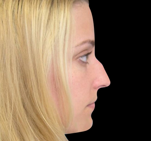 New Jersey Rhinoplasty Before & After Gallery - Patient 55432565 - Image 3