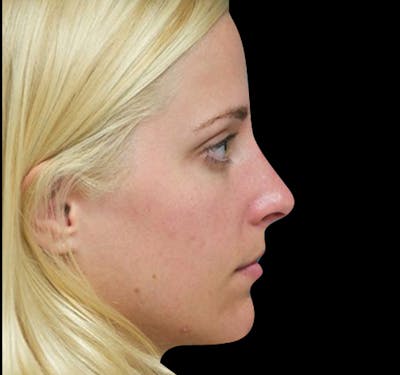 New Jersey Rhinoplasty Before & After Gallery - Patient 55432565 - Image 4
