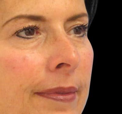 Fillers Before & After Gallery - Patient 55432585 - Image 2