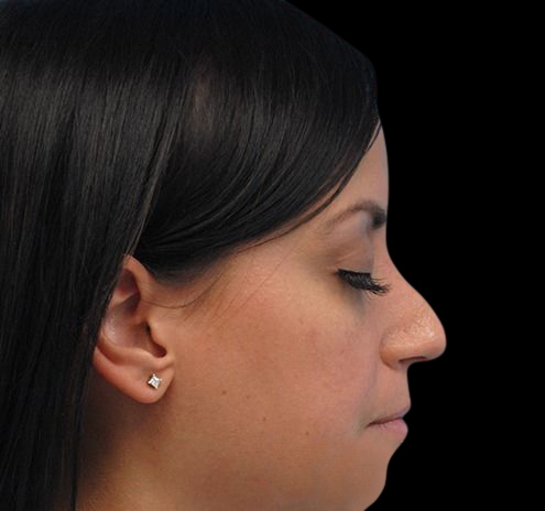 New Jersey Non-Surgical Rhinoplasty Before & After Gallery - Patient 55438566 - Image 9