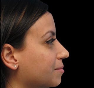 New Jersey Non-Surgical Rhinoplasty Before & After Gallery - Patient 55438566 - Image 10