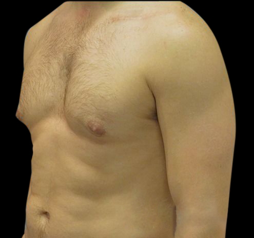 Gynecomastia Before & After Gallery - Patient 55432614 - Image 3