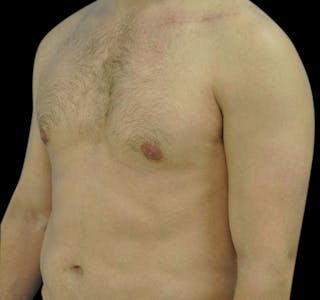 New Jersey Gynecomastia Before & After Gallery - Patient 55432614 - Image 4