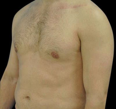 Gynecomastia Before & After Gallery - Patient 55432614 - Image 4