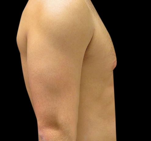 Gynecomastia Before & After Gallery - Patient 55432614 - Image 5
