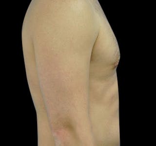 New Jersey Gynecomastia Before & After Gallery - Patient 55432614 - Image 6