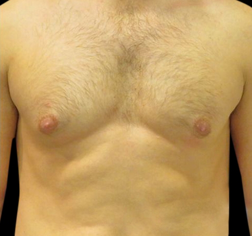 New Jersey Gynecomastia Before & After Gallery - Patient 55432614 - Image 1