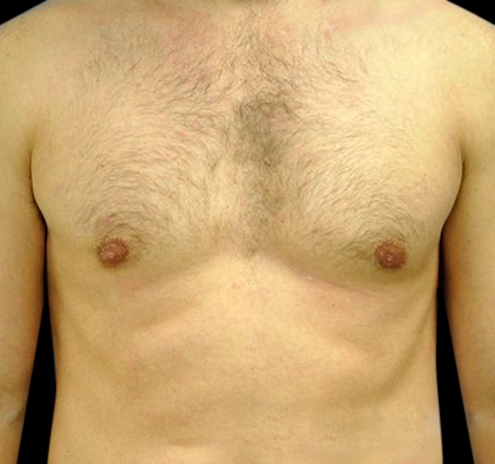 New Jersey Gynecomastia Before & After Gallery - Patient 55432614 - Image 2