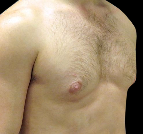 New Jersey Gynecomastia Before & After Gallery - Patient 55432614 - Image 7