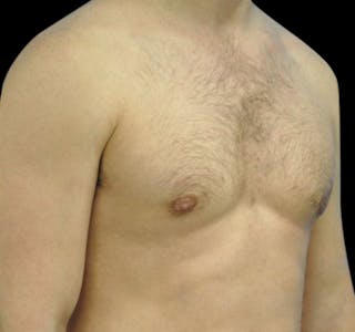New Jersey Gynecomastia Before & After Gallery - Patient 55432614 - Image 8