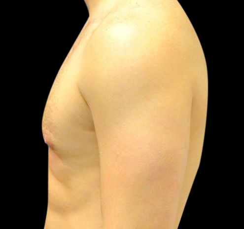 New Jersey Gynecomastia Before & After Gallery - Patient 55432614 - Image 9