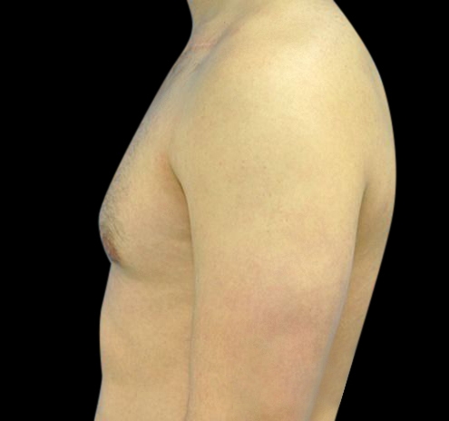 Gynecomastia Before & After Gallery - Patient 55432614 - Image 10