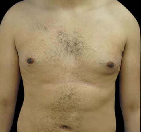 New Jersey Gynecomastia Before & After Gallery - Patient 55432624 - Image 1