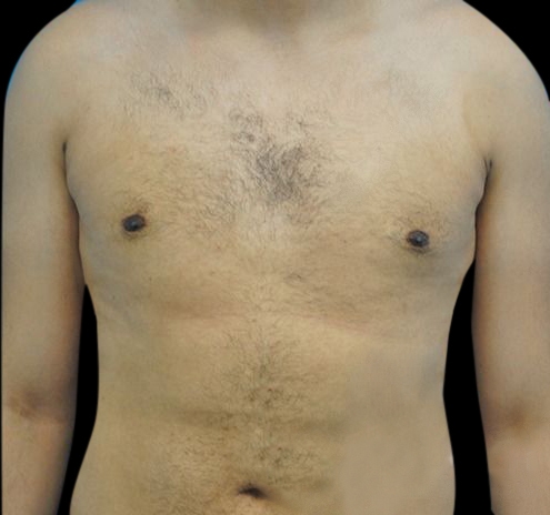 New Jersey Gynecomastia Before & After Gallery - Patient 55432624 - Image 2